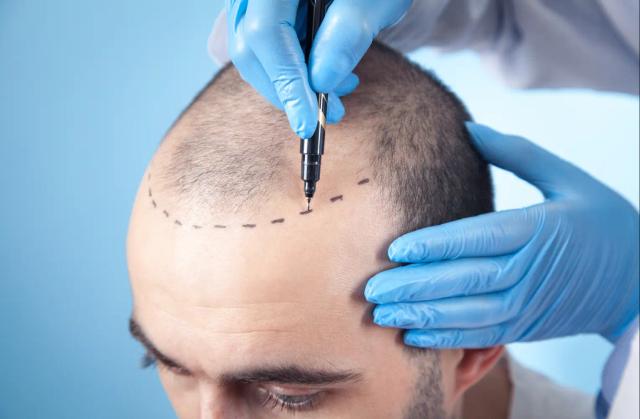 Restore your hair with<br/>a hair transplant.